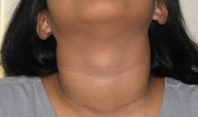 Отёчности шеи в области щитовидки