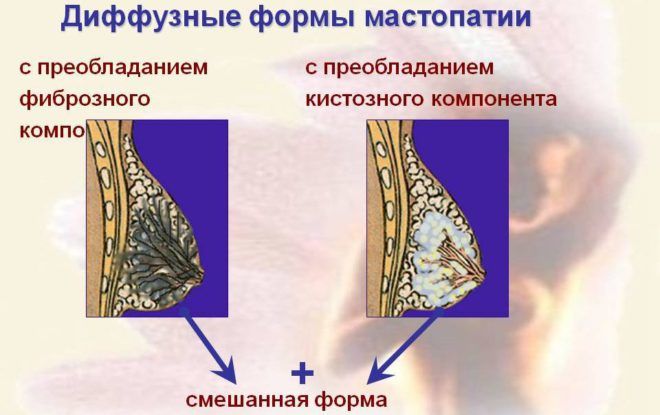 Диффузные формы мастопатии