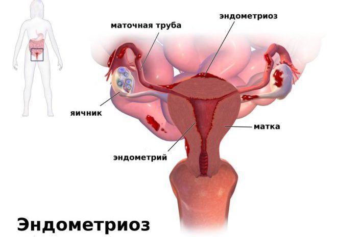 Эндометриоз генитальной области