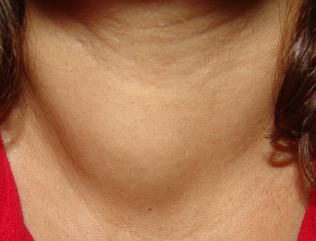 Коллоидный узел щитовидной железы