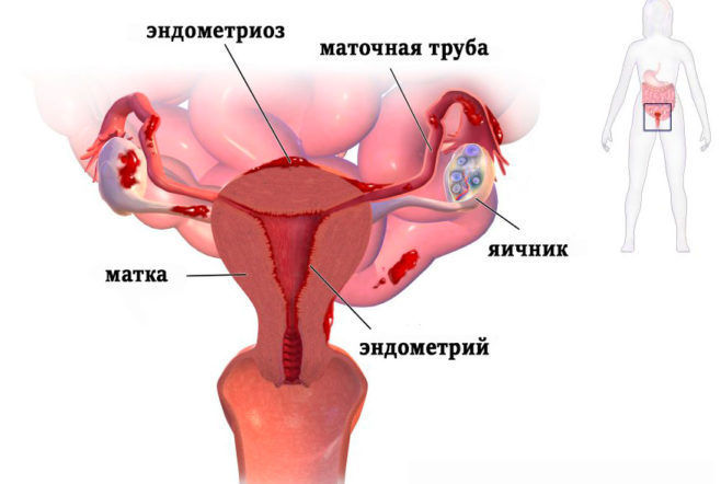 Механизм развития эндометриоза