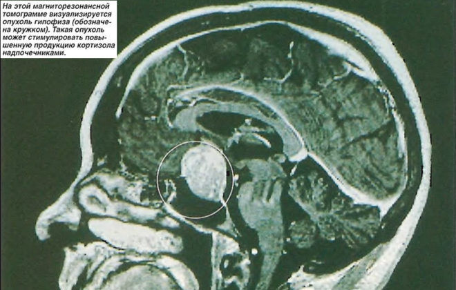 На магниторезонансной томограмме визуализируется опухоль гипофиза