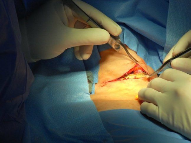  Операции по полной резекции щитовидной железы