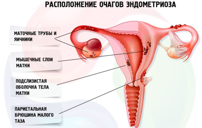 Расположение очагов при эндометриозе