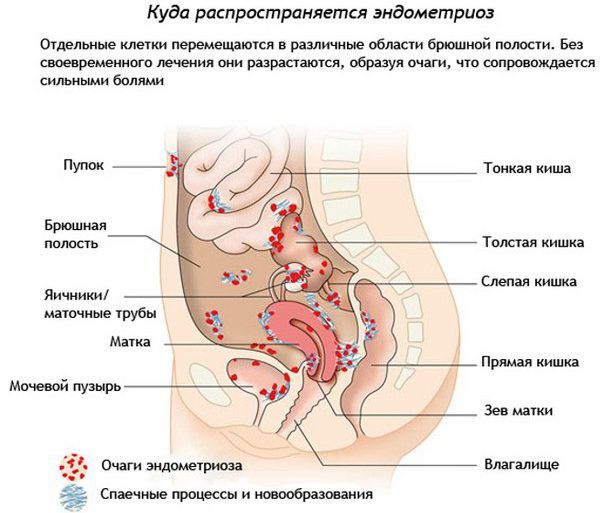 Развитие эндометриоза