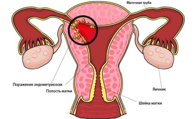 Эндометриоз матки