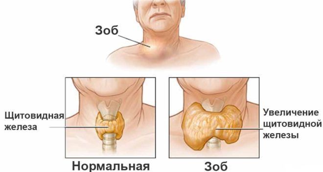 Гиперплазия щитовидки