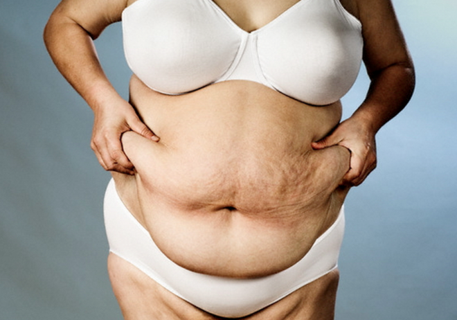 Людям страдающим ожирением противопоказано лечение гормональными препаратами