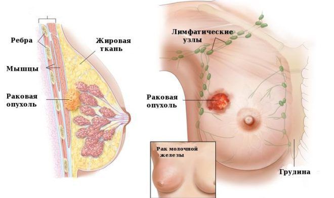Рак молочных желез