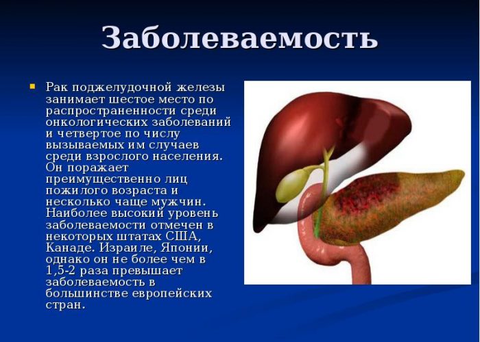 Онкология поджелудочной железы