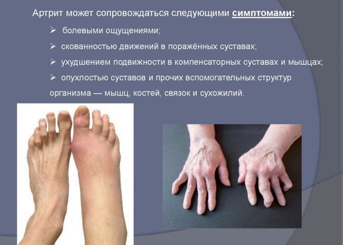 Изображение - Гормоны влияющие на суставы Artrit-700x500
