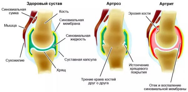 Изображение - Гормоны влияющие на суставы Artrit-i-artroz-e1541417976673