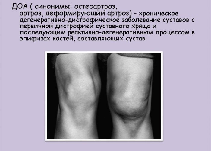 Изображение - Гормоны влияющие на суставы Artroz-700x500