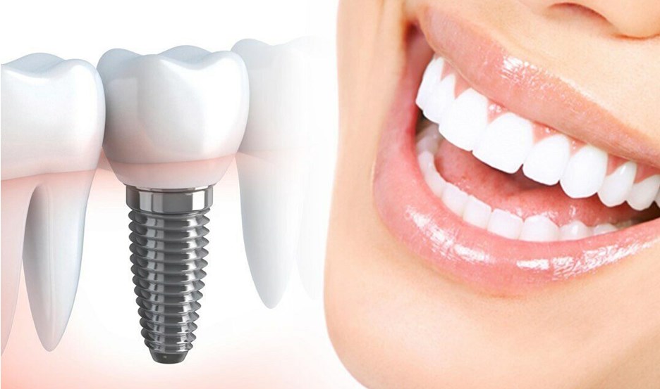 Преимущества имплантации зубов при протезировании