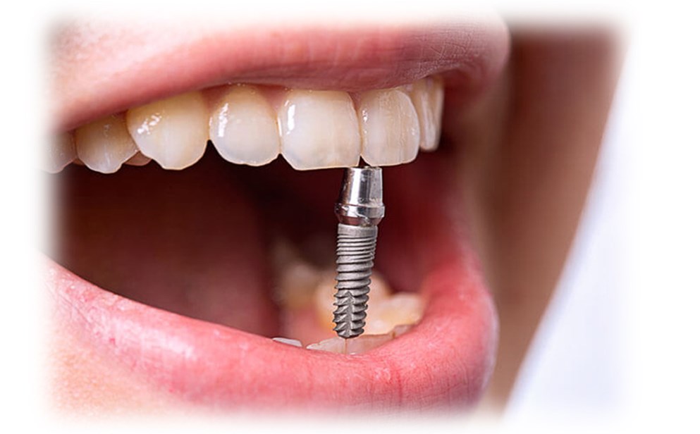 Преимущества имплантации зубов при протезировании