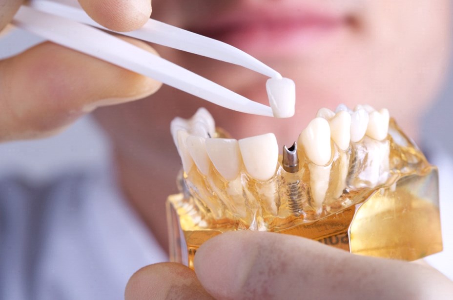 Протезирование зубов от специалиста